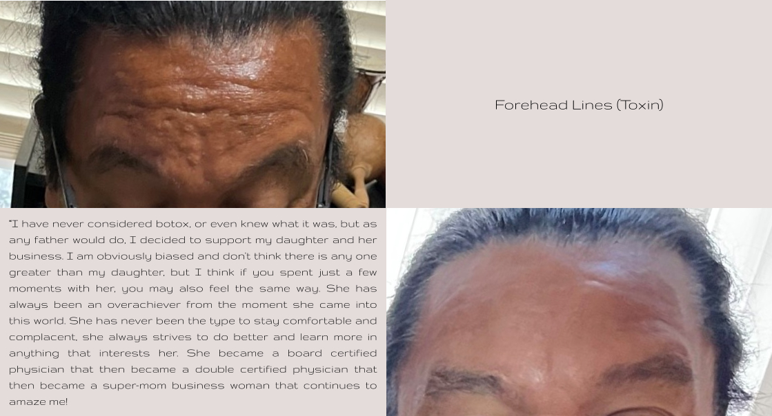 Forehead Lines (Toxin) “I have never considered botox, or even knew what it was, but as any father would do, I decided to support my daughter and her business. I am obviously biased and don't think there is any one greater than my daughter, but I think if you spent just a few moments with her, you may also feel the same way. She has always been an overachiever from the moment she came into this world. She has never been the type to stay comfortable and complacent, she always strives to do better and learn more in anything that interests her. She became a board certified physician that then became a double certified physician that then became a super-mom business woman that continues to amaze me!