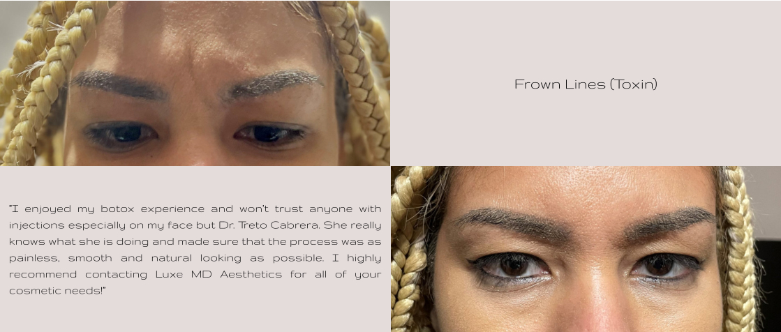Frown Lines (Toxin) “I enjoyed my botox experience and won’t trust anyone with injections especially on my face but Dr. Treto Cabrera. She really knows what she is doing and made sure that the process was as painless, smooth and natural looking as possible. I highly recommend contacting Luxe MD Aesthetics for all of your cosmetic needs!”