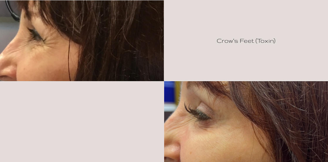 Crow’s Feet (Toxin)