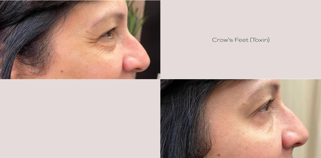 Crow’s Feet (Toxin)