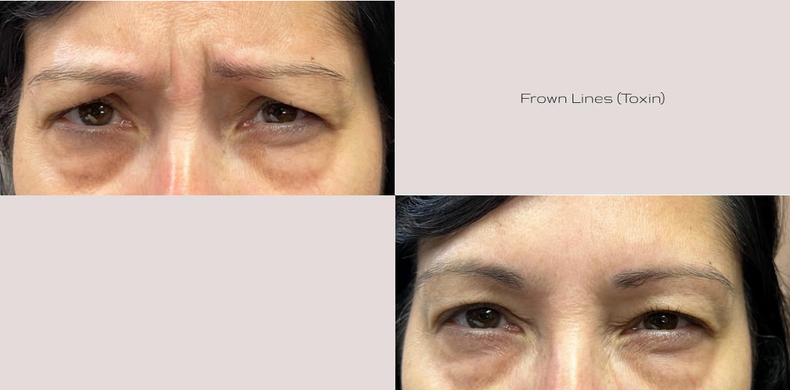 Frown Lines (Toxin)
