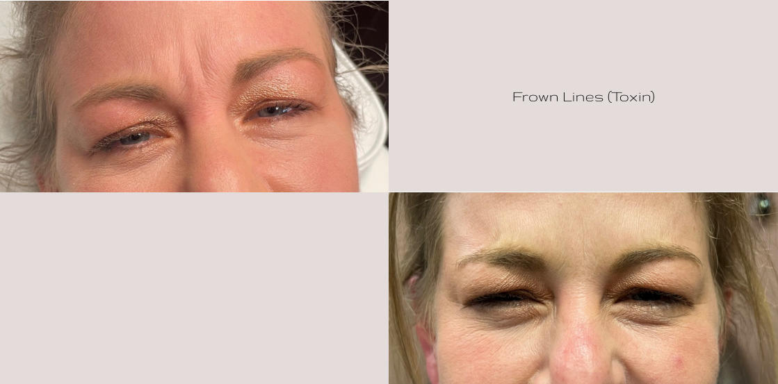Frown Lines (Toxin)